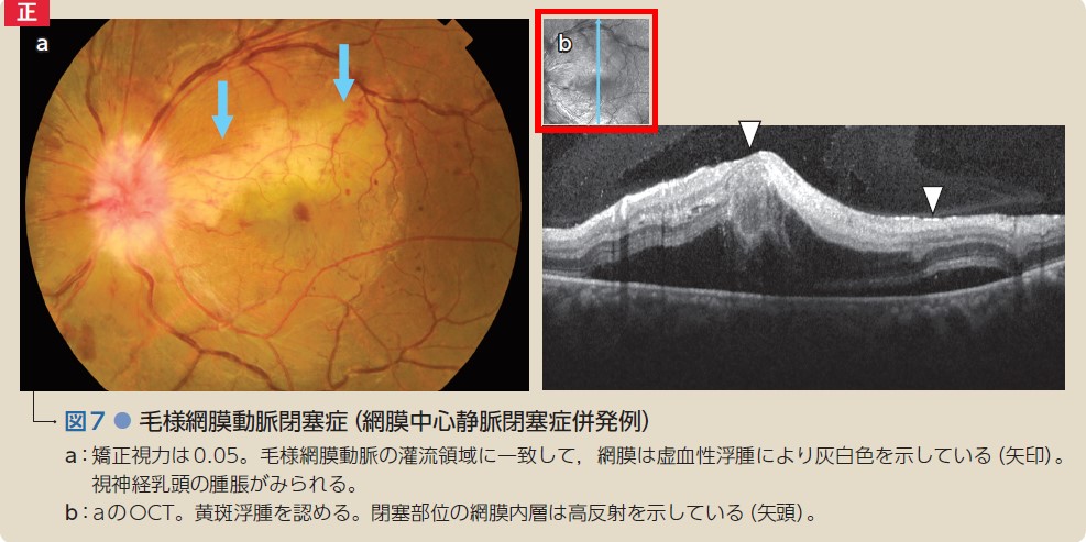 カラーアトラス眼底図譜 – 日本医事新報社